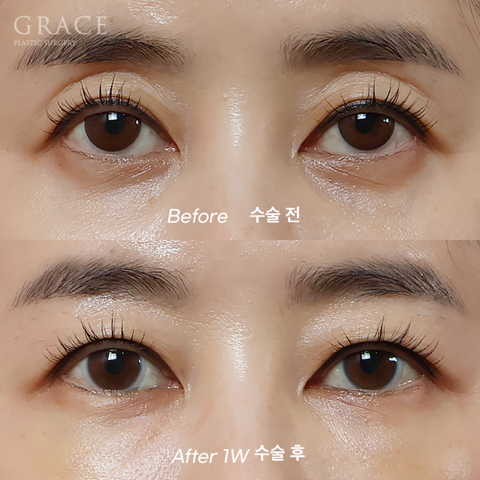 Under-Eye Fat Repositioning & Eyelid Fat Grafting: Double the Swelling? Before and After 1 Week image 1