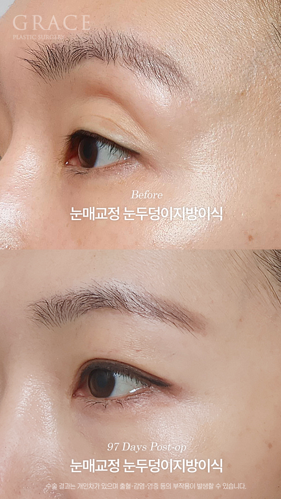 그레이스성형외과 눈두덩이 지방이식 1차로 끝내지 않은 진짜 이유 관련 이미지 6