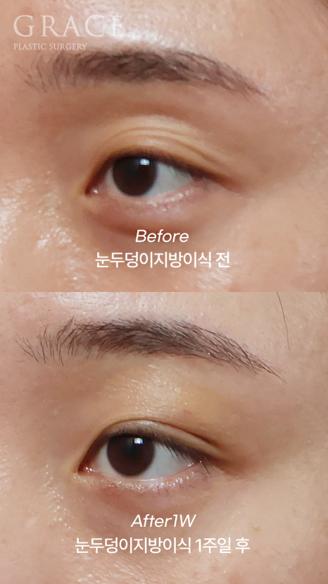Understanding the Difference Between Forehead Fat Grafting (Eye Hollow Fat Grafting) and Fillers image 3