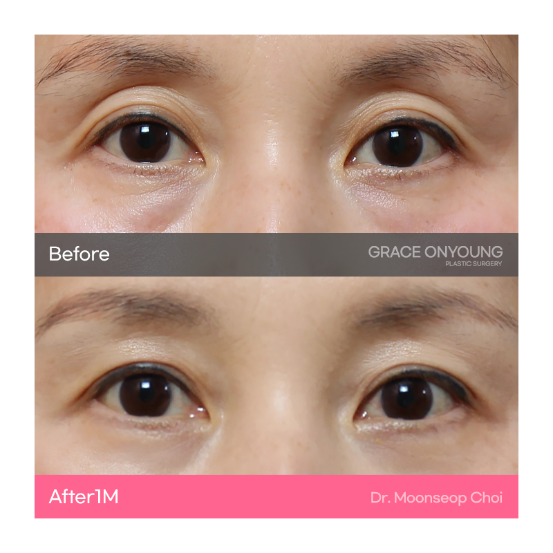 Eyelid Fat Grafting (Sunken Eye Hollowing) image 2