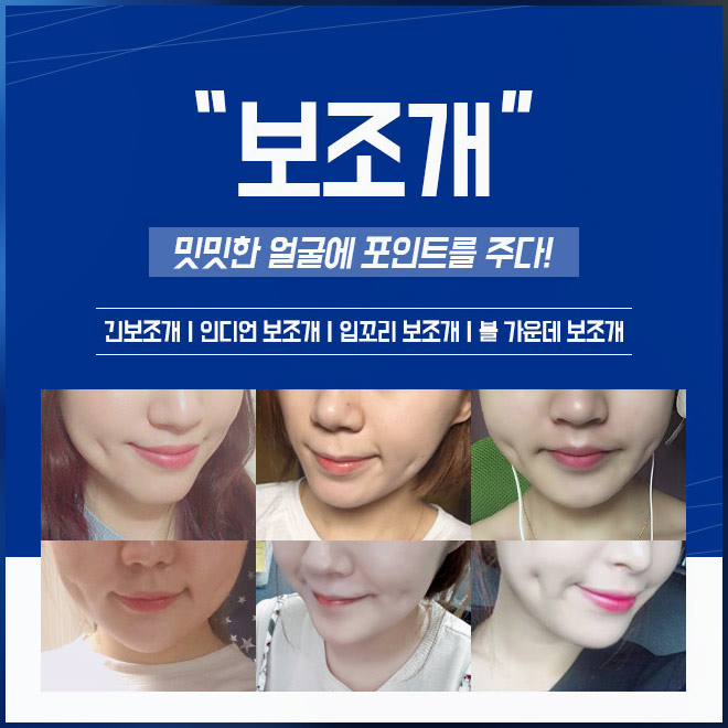 매력적인 웃음의 포인트, 보조개수술방법 관련 이미지 4