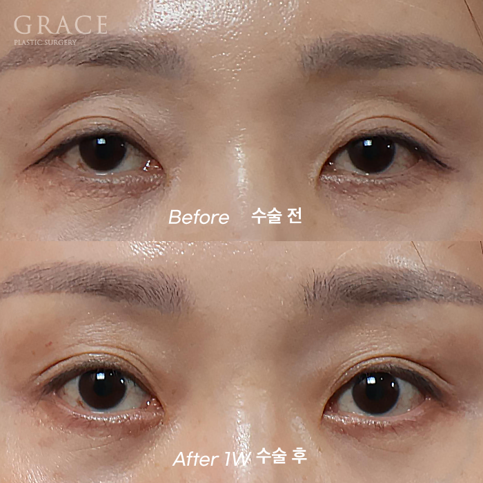 Sunken Upper Eyelids? With Just 0.9cc of Injection for Eye Hollow Fat Grafting image 1