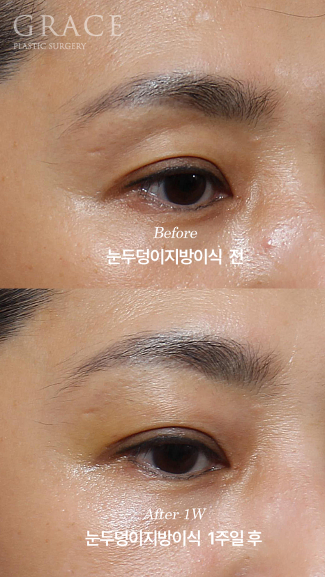 눈두덩이 부위에 절개해서 지방을 넣는다? 그레이스성형외과 아이홀 지방이식 방식에 대한 오해 관련 이미지 3