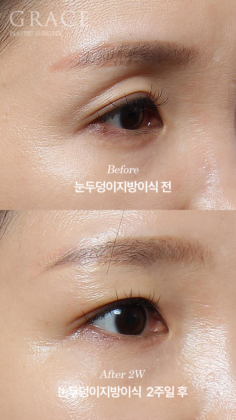Double Eyelid Fat Grafting Fails When It Becomes Visible and Bumpy? image 5
