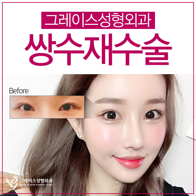 마지막 쌍수재수술 후기는 이곳에서 관련 이미지 5