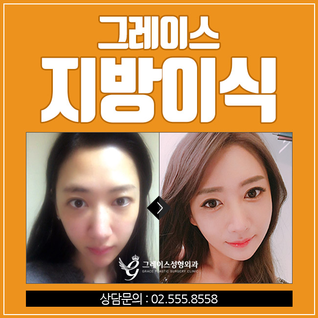 생기있고 탱탱한 동안얼굴, 그레이스성형외과 얼굴지방이식이 정답! 관련 이미지 3