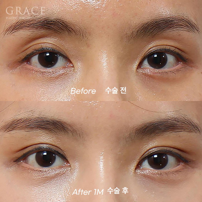 Side Effects of Eyelid Fat Grafting? One-Month Engraftment Period When Eyelid Correction Is Performed image 7