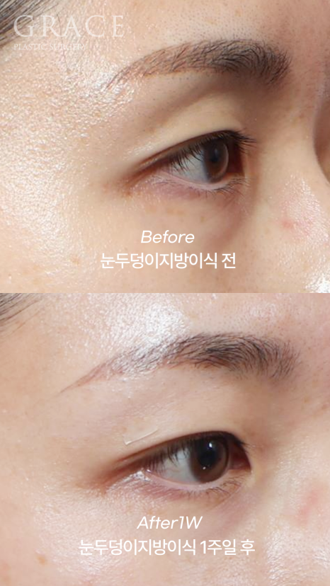 Eyebrow Fat Grafting &middot; Eyelid Fat Grafting &middot; Sunken Eyes Surgery Cost Information (As of June 2025) image 6