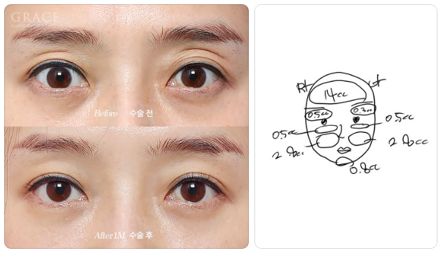 아이홀 지방이식 vs 아이홀 필러 관련 이미지 8