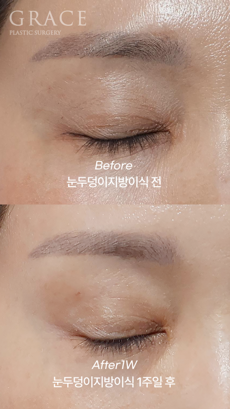 Sunken Upper Eyelids? With Just 0.9cc of Injection for Eye Hollow Fat Grafting image 4