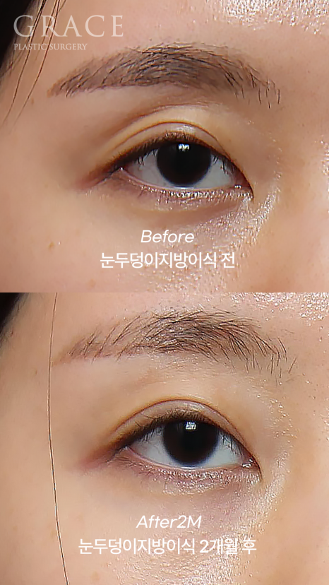 Upper Eyelid Fat Grafting That Shows When You Close Your Eyes? The Cause of Side Effects Is Different image 1