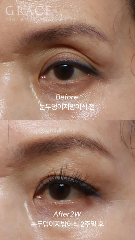 Concerns About Swelling and Side Effects After “Eye Hollow Fat Grafting” Surgery in the Eye Socket Area for People in Their 60s image 6