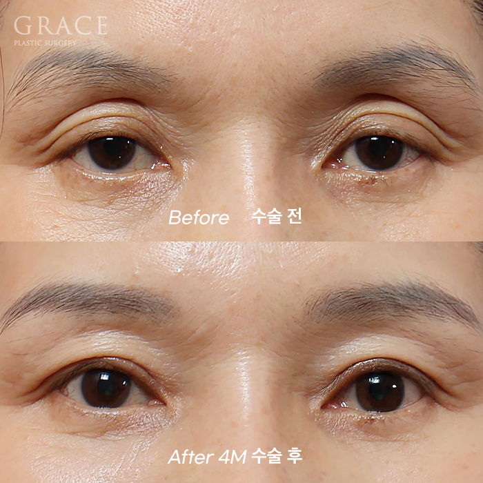 Upper Eyelid Fat Grafting Before and After in a Person in Their Late 50s and a Person in Their Late 20s image 4