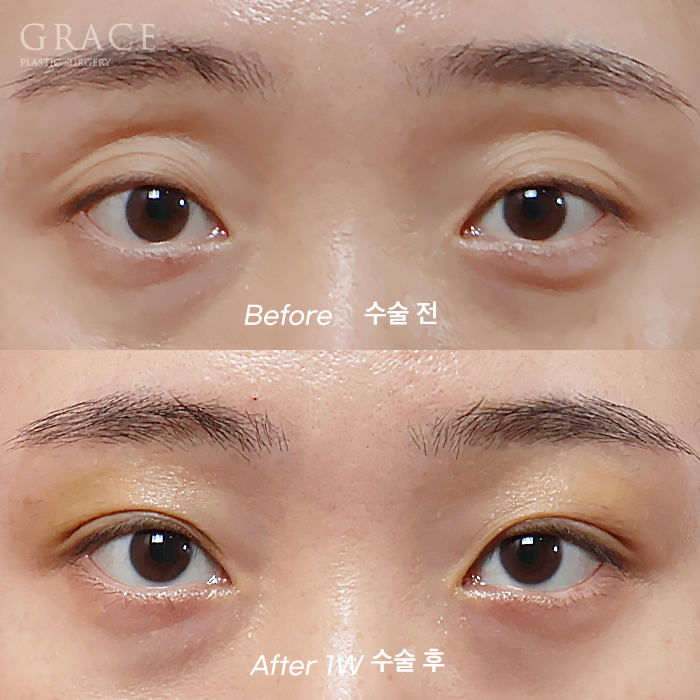 Understanding the Difference Between Forehead Fat Grafting (Eye Hollow Fat Grafting) and Fillers image 2