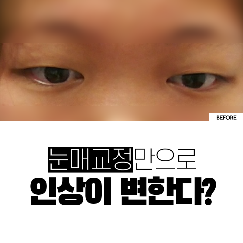 비절개눈매교정 전후 알아보자💕 관련 이미지 2