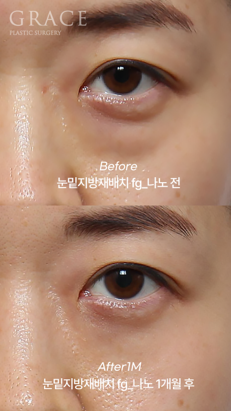 눈밑지방재배치 vs 눈두덩이지방이식｜부작용과 붓기 등 관련 이미지 1