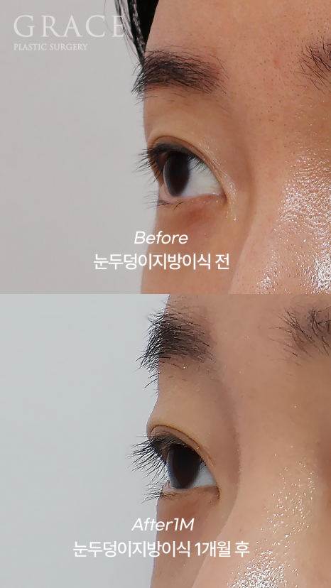 …The Result of Eyelid Fat Grafting (If You’re Worried About Side Effects and Swelling) image 4