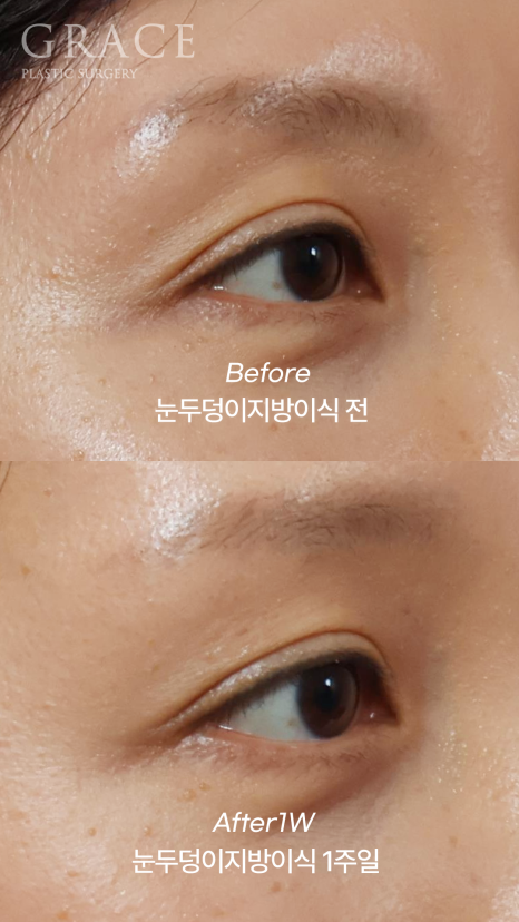 Fat Removal After Double Eyelid Surgery? Eyelid Fat Grafting After Double Eyelid Surgery Before & After image 4