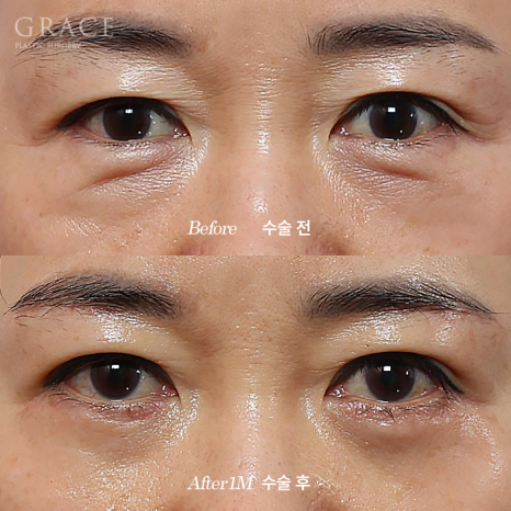 60대 눈밑성형 하안검과 눈밑지방재배치 차이 관련 이미지 3