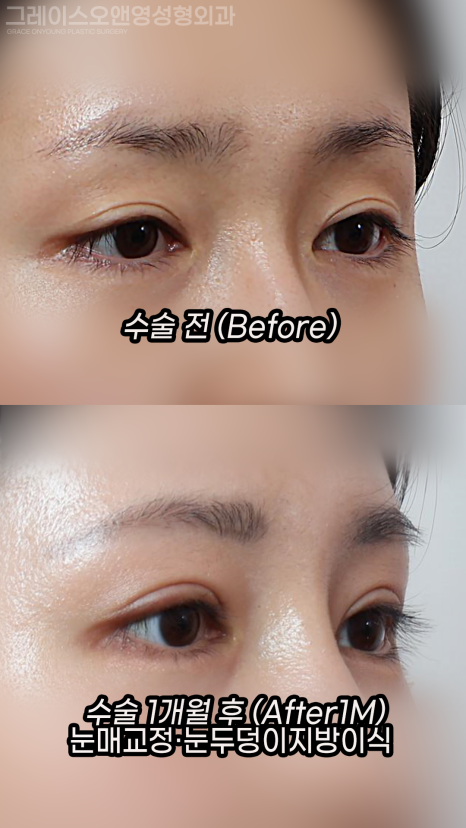 눈매교정 재수술 (절개) 아이홀 지방이식 1차 관련 이미지 3