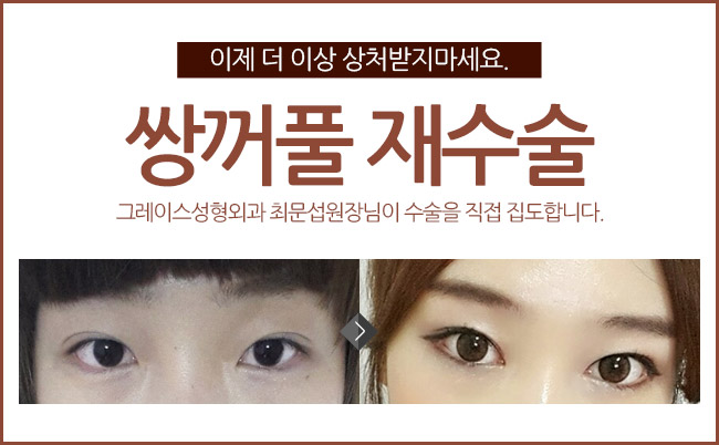 그레이스성형외과 최문섭원장님이 직접 집도하는 눈재수술 관련 이미지 3