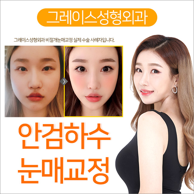 안검하수눈매교정 여기가 정답! 관련 이미지 3