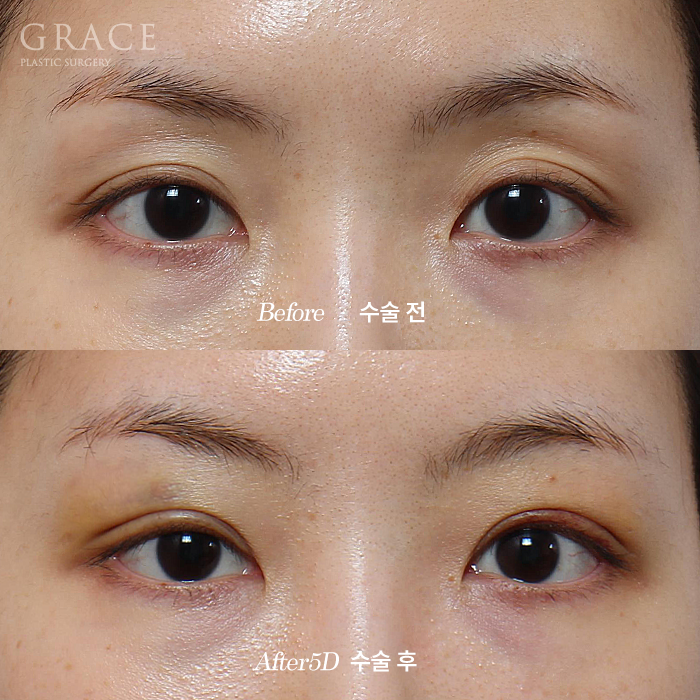 그레이스성형외과 Before&middot;After 아이홀 지방이식 잘하는 곳 관련 이미지 1
