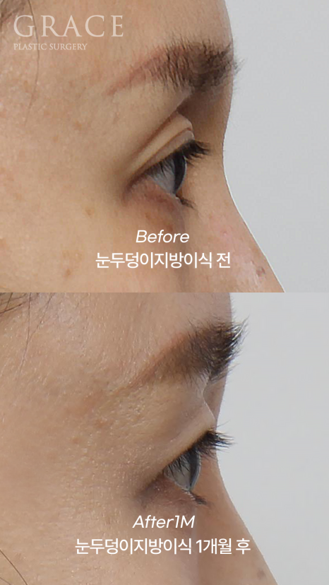 눈두덩이 감으면 울퉁불퉁? 아이홀 지방이식 진실 관련 이미지 5