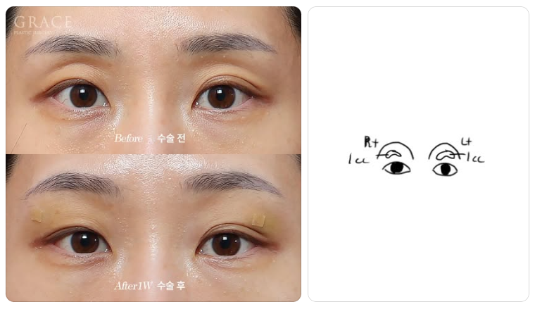The Real Cause of Side Effects from Upper Eyelid Fat Grafting: the Injection Layer (Orbicularis Oculi Muscle & Orbital Fat) image 1