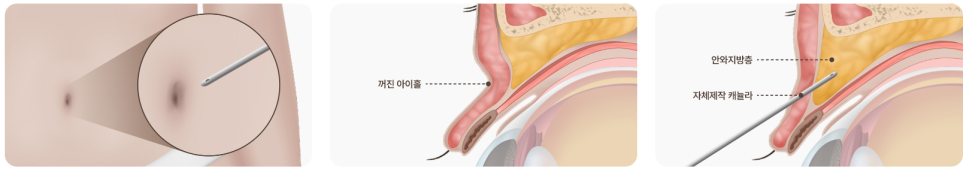 눈꺼풀 지방이식 부작용 왜 생기는지 아시나요? 관련 이미지 1