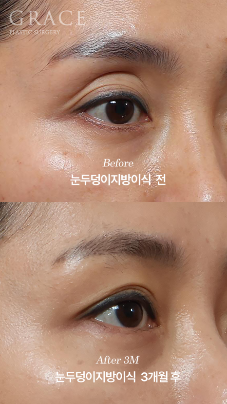안와지방 주입 &middot; 눈두덩이지방이식 (1cc / 0.9cc) 관련 이미지 5