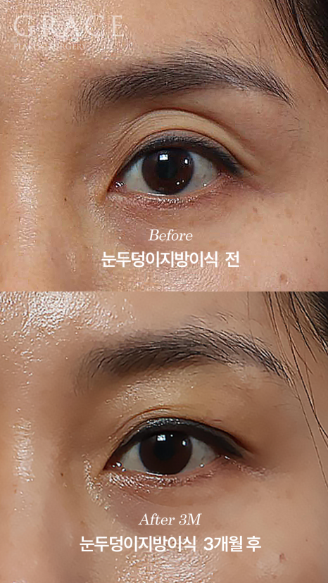 안와지방 주입 &middot; 눈두덩이지방이식 (1cc / 0.9cc) 관련 이미지 3