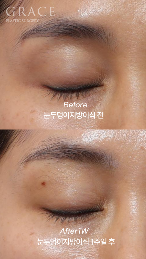 Sagging Eye Hollows and Sunken Eyelid Fat Grafting: Reasonable Cost (Price) Information and image 2