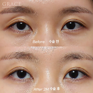 Why Eyelid Hollow Fat Grafting and Orbital Fat Injection Are Important: From Duration of Results to How to Prevent Bumpy Side Effects image 1