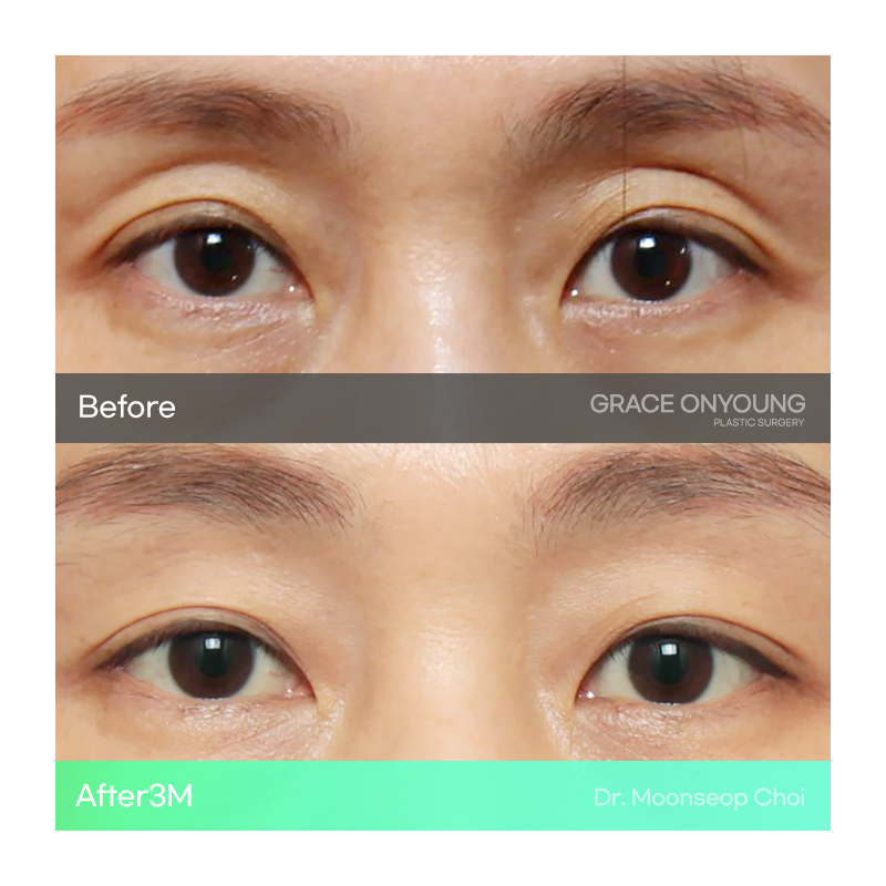 Shocked After Hearing That My Hollow Eyes and Sunken Eye Holes Were Severe? Upper Eyelid Fat Grafting image 1