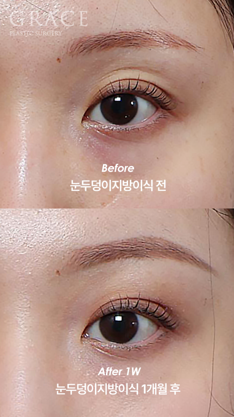 눈을 감았을 때 보이는 멍·흉터·울퉁불퉁함 걱정되나요? 눈두덩이 지방이식 관련 이미지 4