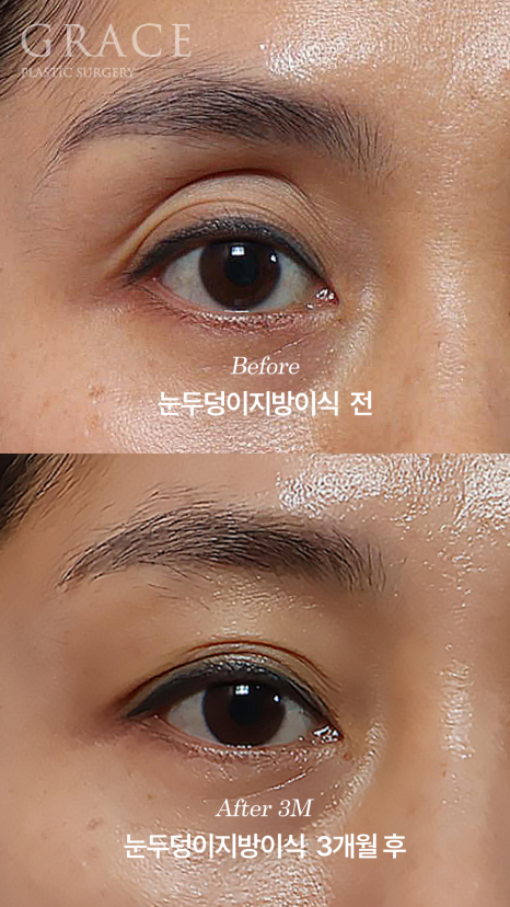 안와지방 주입 &middot; 눈두덩이지방이식 (1cc / 0.9cc) 관련 이미지 1