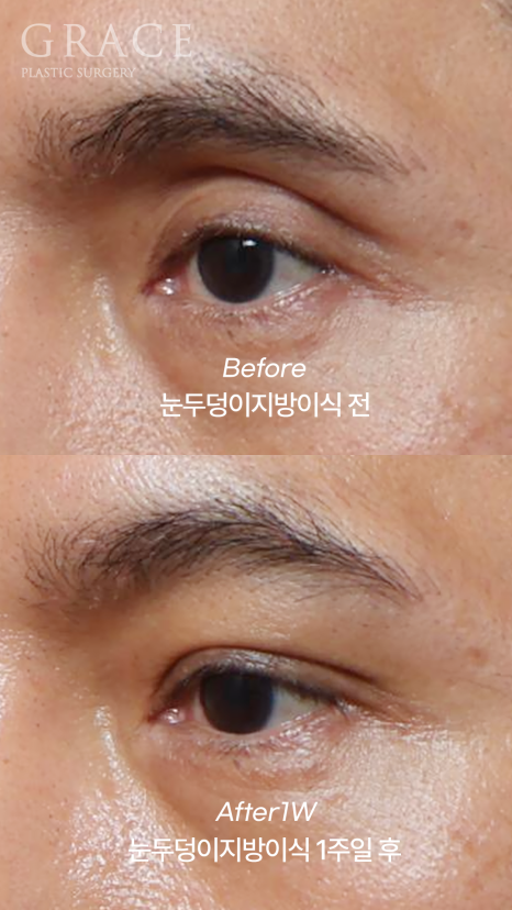 Male Brow Filler? Improvement with Eye-Hole Fat Grafting (Without Worrying About Side Effects, Scars, or Swelling) image 2