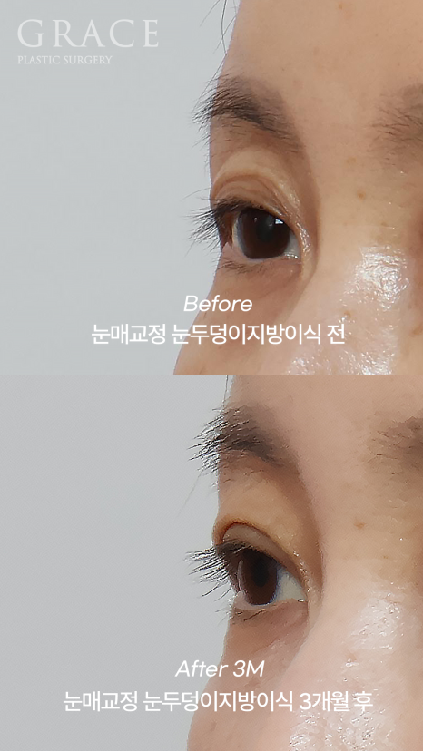 눈꺼풀 지방이식 생착률이 관건이라고? 1개월 회복의 과정 관련 이미지 8