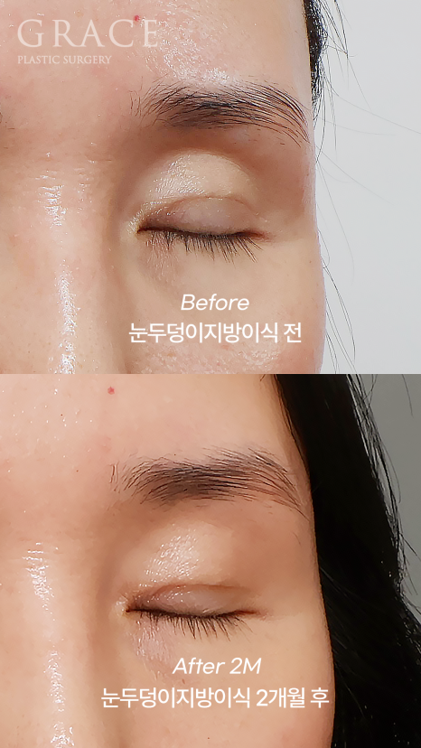 Why Do Hollow Eyelids Occur, and How Can They Be Naturally Improved? (Research Notes from a Doctor Performing Eyelid Fat Grafting) image 6