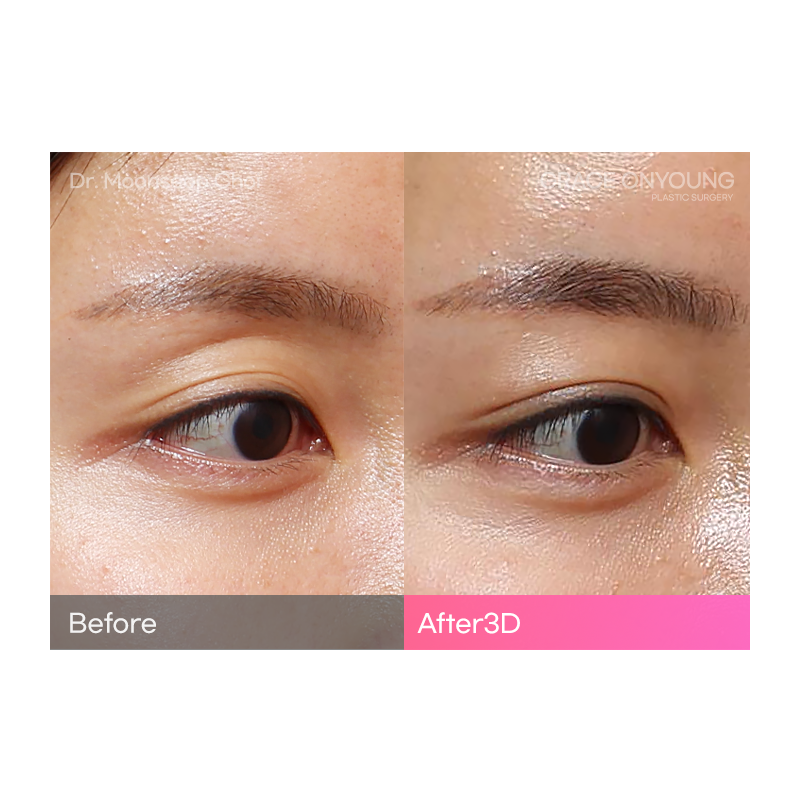 Are You Considering Fat Grafting for Hollow Upper Eyelids? image 6
