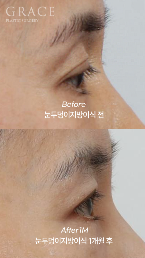 눈꺼풀 지방이식 절개 없이 아이홀 부위를 채우기 관련 이미지 9