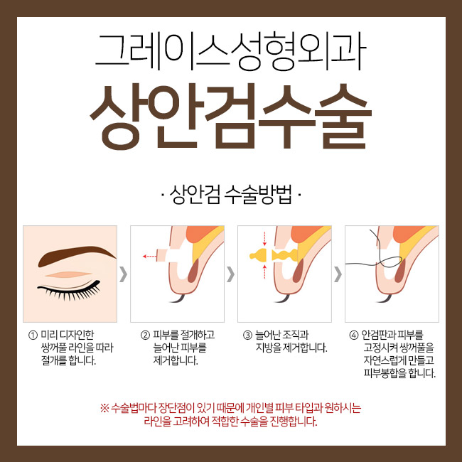 처지고 늘어진 눈꺼풀, 그레이스성형외과 상안검수술로 해결하세요! 관련 이미지 4