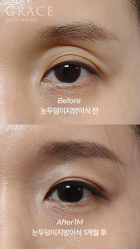 눈두덩이 감으면 울퉁불퉁? 아이홀 지방이식 진실 관련 이미지 1