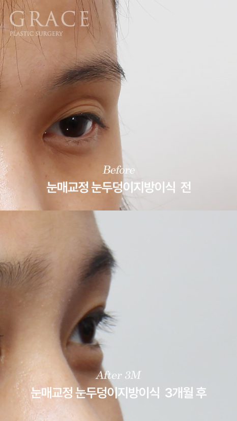 눈두덩이지방이식 붓기 언제 빠질까? 부작용&middot;유지기간까지 1주&middot;3개월&middot;6개월 변화 관련 이미지 7