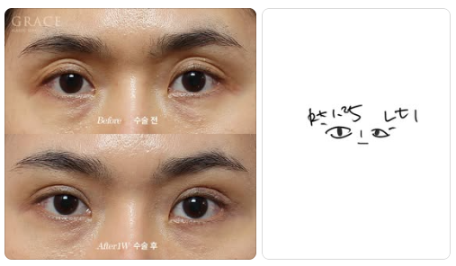 꺼진 아이홀 지방이식, 울퉁불퉁 부작용 오해 바로잡기 관련 이미지 3