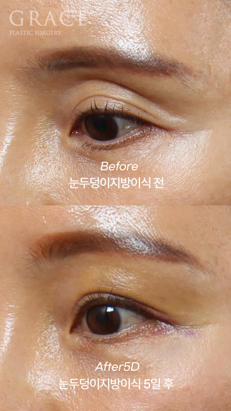 How Long Can Sunken Upper Eyelids Last Without Side Effects After Fat Grafting? image 3
