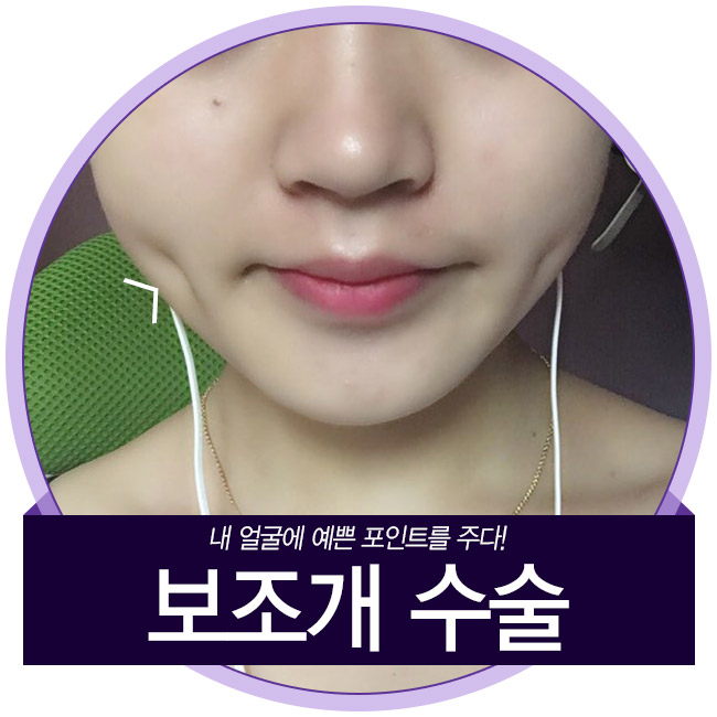핫한 보조개수술, 신사역 그레이스성형외과에서 관련 이미지 1