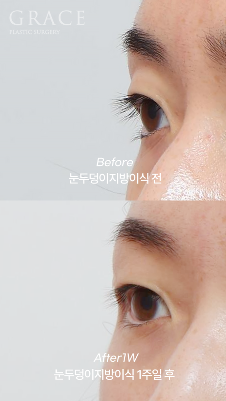 Eyebrow Fat Grafting &middot; Eyelid Fat Grafting &middot; Sunken Eyes Surgery Cost Information (As of June 2025) image 4