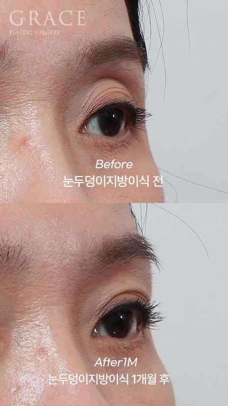 Upper Eyelid Fat Grafting Cost · Swelling, Reviews & Side Effects image 3